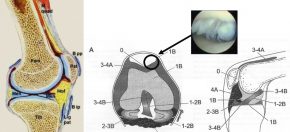 Abb 1: Fem: Oberschenkelknochen Pat: Kniescheibe Hof: Hoffa‘scher Fettkörper Men: Meniskus Tib: Schienbein Lig.pat: Patellar Sehne Mquad: Quadricepsmuskel / Abb 2: „Schmerzaufzeichnung“ bei OP ohne Narkose und „zufällig“ diagnostizierter Knorpelschaden Quelle: Scott Dye, San Francisco, USA