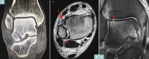 3 Bruch des Sprungbeins / 4 Syndesmosenriss / 5 Osteochondrale Fraktur des Sprungbeins