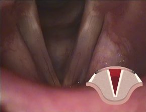Die Stimmlippen schematisch dargestellt und wie sie der Arzt mit dem Endoskop sieht.