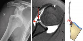 Schulterluxation: Links zeigt die luxierte Schulter / Mitte zeigt ein MR Bild der abgerissenen Gelenkslippe / Rechts zeigt die refixierte Gelenklippe mit arthroskopischer Ankertechnik