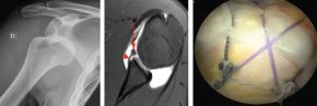 Sehnenriss = Rotatorenmanschettenriss: links: Riss der Sehne im MR / Mitte: Schema der Sehnenrefixation / rechts:Arthroskopie-Bild der refixierten Sehne
