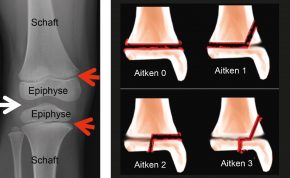 1 Röntgen Bild des Knie­gelenks eines 10 jährigen. Die roten Pfeile zeigen die Wachstumsfugen des Oberschenkelkochens und des Unterschenkelknochens. Der weiße Pfeil markiert den Gelenksspalt / 2 Einteilung der Verletzungen nach Aitken