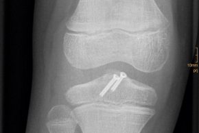 6 OP Röntgen einer kindlichen knöchernen Kreuzbandverletzung