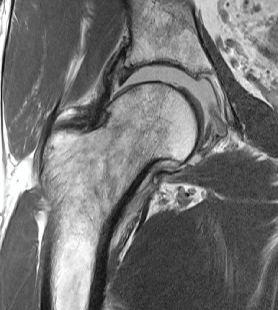Auf dem MRT-Bild ist das Hüft­gelenk auch für Laien erkennbar. Der Fachmann sieht den Knorpelschaden am Pfannendach und am Hüftkopf.