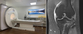 Das 3-Tesla-MRI in der Privatklinik Hochrum zur präzisen Diagnose von Verletzungen aller Art / MR einer akuten Knieverletzung