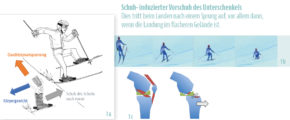 Schuh- induzierter Vorschub des Unterschenkels