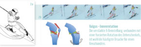 Valgus – Innenrotationsmechanismus