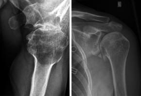 Das linke Bild zeigt eine ausgeprägte Abnutzung der Schulter bei einem 48jährigen ehemaligen Eishockey-Profi, der in der Jugend unter mehrfachen Schulterluxationen gelitten hat. Durch die Luxationen und die Instabilität hat sich eine ausgeprägte Arthrose mit Knochenanbauten unterhalb des Oberarmkopfes gebildet. Das rechte Röntgenbild zeigt die Schulter nach arthroskopischem Abtragen der Knochennasen, Mobilisierung des Gelenkes und Versetzen der langen Bizepssehne an den Oberarm.
