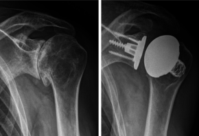 Das linke Bild zeigte eine eingeschliffene Arthrose der Schulter und rechts im Bild die anatomische Prothesenversorgung mit Knochenaufbau an der Schulterpfanne und einem schaftfreien Humeruskopfersatz.