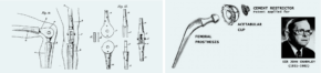 Das Elfenbeinknie von Gluck war als einfaches Scharnier konzipiert. (Bildquelle BMJ 1992; 305:1534-6) / John Charnley´s Hüftimpantat hatte bereits viele Merkmale, die auch bei modernen Hüftimplantaten noch zu finden sind.