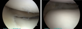 Patient mit fehlendem Außenmeniskus, der Knorpel ist noch weitgehend gesund / Gleicher Patient mit transplantiertem Außenmeniskus