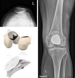 Schwere Kniescheibengelenksarthrose: Die Patella ist deformiert, ein großer Knochenteil steht an der Außenseite wie ein Geier­schnabel über und scheuert dort. / Bild nach Patellofemoralgelenksprothese: Schön zu sehen, dass der Gelenkteil zwischen Oberschenkel und Unterschenkel nicht ersetzt ist, die Menisci und Bänder bleiben erhalten. / Mit modernen Implantaten kann die Gelenkoberfläche anatomisch ersetzt werden / Die Rückfläche der Kniescheibe wird mit einer Gleitfläche aus Polyethylen ersetzt