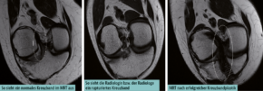 Vorderes Kreuzband im Blickfeld: So sieht ein normales Kreuzband im MRT aus / So sieht die Radiologin bzw. der Radiologe ein rupturiertes Kreuzband / MRT nach erfolgreicher Kreuzbandplastik