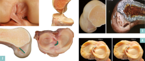 2 Anatomie: Flaches vorderes Kreuzband mit linearem Ansatz am Oberschenkel und C-förmigem Ansatz am Schienbeinkopf (grün) / 3 Vergleich Anatomie – 3D-CT einer flachen Kreuzbandrekonstruktion am Oberschenkel / 4 Vergleich Anatomie – 3D-CT einer C-förmigen Kreuzbandrekonstruktion am Schienbein