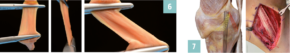 6 unterschiedliche Erscheinungsbilder eines flachen Bandes je nach Blickwinkel und Anspannung der Fasern / 7 Anatomie des flächigen medialen Knieseitenbandes mit oberflächlichem Seitenband (schwarz), tiefem Seitenband (gelb) und hinterem Schrägband (rot) und Resultat einer flachen Rekonstruktion eines oberflächlichen und tiefen Knieseitenbandes