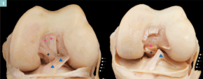 1 Anatomisches Präparat eines Kniegelenkes in der Ansicht von vorne; links mit intakten Bändern, rechts mit durchtrennten: hinteres Kreuzband (Stern pink) Meniscofemorales Band (schwarzes Kreuz), vorderes Kreuzband (blaue Dreiecke), Außenband (kleine weiße Pfeile)