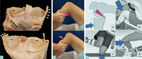 2 Anatomisches Präparat eines Schienbeinkopfes von hinten bzw. oben. Hinteres Kreuzband (pinke Sterne), Außenband (kleine weiße Pfeile), Ansatzsehne des Popliteusmuskels (gefüllte schwarze Pfeile), Innenband (gefüllte weiße Pfeile), meniscofemorales Band (schwarzes Kreuz) 3 Schubladen-Test 4 Verletzungsmechanismen: Krafteinwirkung auf das gebeugte Kniegelenk von vorne (4a), Hochenergietrauma (4b) Sturz auf den oberen Teil des Unterschenkels (Abb. 4c,d).