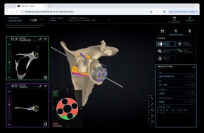 3D Modell des Schulterblattes und der Schulterpfanne mit der Basisplatte der Prothese. Diese gibt den Sitz des gesamten Implantates vor und ist somit für das Ergebnis entscheidend.