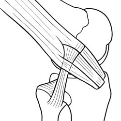 Laterale Tenodese (modifizierte Technik nach Ellison): Ein ca. 1cm breiter Streifen des Tractus iliotibialis wird unter dem lateralen Seitenband umgeleitet und verbessert die Rotationsstabilität.
