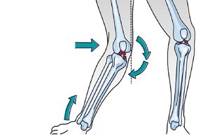 Typischer Verletzungsmechanismus des VKB