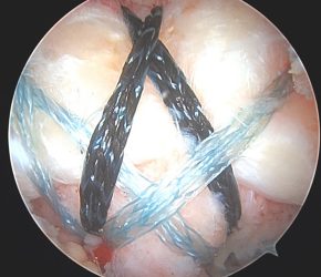 Arthroskopische Naht der Rotatorenmanschette