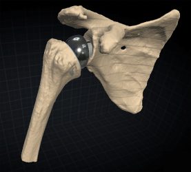Bild einer inversen Schulterprothese aus der individuellen 3D Planungssoftware