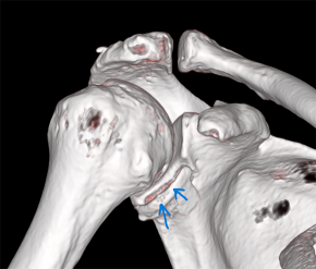 Das 3D-Schulter-CT zeigt die genaue Darstellung der Fraktur am Pfannenrand.