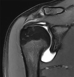 Arthro-MRT der Schulter: Der Gelenksraum wurde mit Flüssigkeit „aufgespannt“.